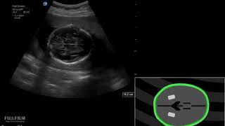 3D Animation Pregnancy BPD HC AC and FL Measurements [upl. by Amadeo]