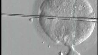 Human embryo  biopsy procedure by displacement method PGDPGSmpg [upl. by Sitarski]