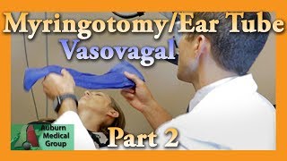 Myringotomy amp Ear Tube Part 2 Vasovagal Feat Dr Tim Fife  Auburn Medical Group [upl. by Greenwell]