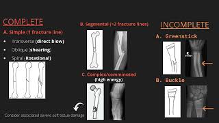 Approach to describing fractures on xray [upl. by Nevag]