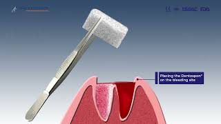 SURGISPON® DENTAL Absorbable Haemostatic Gelatine Sponge [upl. by Varney]