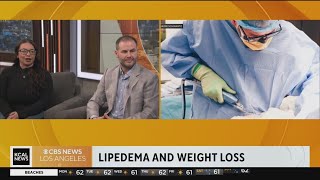 How lipedema can prevent weight loss [upl. by Lewak]