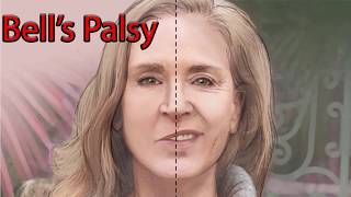 Bells Palsy  Facial Nerve palsy [upl. by Lorrie814]