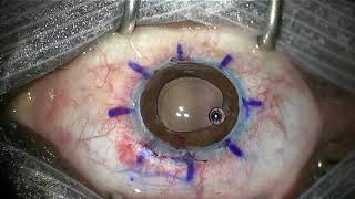 Secondary penetrating keratoplasty  open sky extracapsular cataract extraction ECCE [upl. by Aecila]