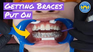 Process of Getting Braces [upl. by Jelks488]