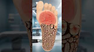 ASMR Infected Foot Treatment asmr satisfying [upl. by Niwrek]