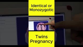 Identical or Monozygotic Twins Pregnancy  Judwa Bachy shorts shortvideo [upl. by Saum]