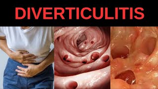 Diverticulitis Symptoms Causes Treatment [upl. by Sidalg]