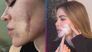 Khloé Kardashian Reveals Just How Scary Her Skin Cancer Situation Was [upl. by Raleigh]