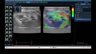 IQ 325 KIDNEY ULTRASOUND ECHOPAC ANALYSIS CRF ELASTOGRAPHY [upl. by Gombach]