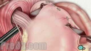 AntiReflux Laparoscopy Surgery PreOp® Patient Education Medical video [upl. by Judi382]