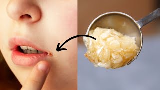 How To Heal Cracked Lip Corners Fast  Get Rid Of Angular Cheilitis Fast At Home [upl. by Ricoriki]