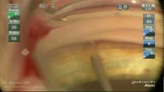 iStent Trabecular MicroBypass Implantation Ike Ahmed [upl. by Ranique904]