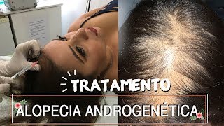 Alopecia Androgenetica tratamento atualização 020218 [upl. by Nadia968]