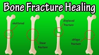 How Does A Bone Break Heal  Bone Fracture Healing Process [upl. by Bowles]