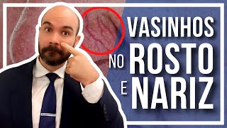 🔴Vasinhos no Rosto e Nariz Porque surgem e como tratar [upl. by Aylsworth]