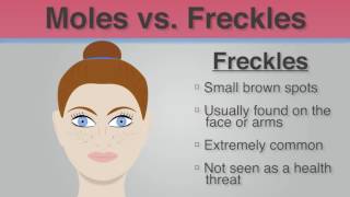 Did You Know  The Difference Between Moles amp Freckles [upl. by Cherlyn]