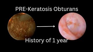 Pre Keratosis Obturans A Condition that Warrants the Cleaning of Ear [upl. by Kraska]