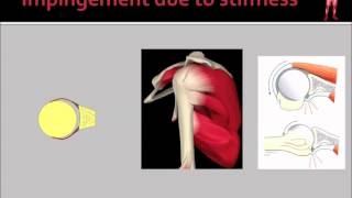 Rotator Cuff Impingement amp Tears [upl. by Aij]