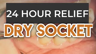 DRY SOCKET TREATMENT  DRY SOCKET PAIN [upl. by Tarrah647]