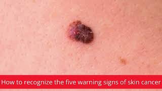 How to recognize the five warning signs of skin cancer │News podcasts [upl. by Quincy64]