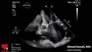 Rheumatic Valvular Heart disease with LA thrombus  Ahmed Esmail [upl. by Varrian]