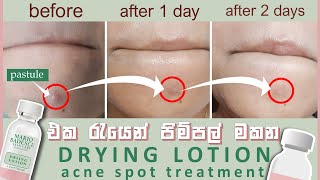 ✔ එක රැයෙන් පිම්පල් මකන  Acne spot treatment  Drying lotion sinhala  oshi vlogs [upl. by Martinson]