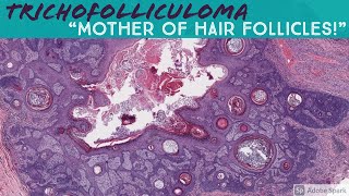 Trichofolliculoma 5Minute Pathology Pearls [upl. by Ysied]