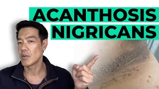 How to treat Acanthosis Nigricans  Dr Davin Lim [upl. by Annaynek445]