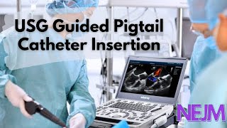 Ultrasound Guided Pleural Pigtail Catheter Placement Tutorial  NEJM  EDAIC  DNB  MD [upl. by Aeslahc]