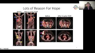 Stage 4 Breast Cancer  Part 34  quotTreatment of stage 4 HER2 positive breast cancersquot [upl. by Analad]