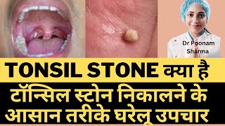 Tonsil Stone क्या है  टॉन्सिल स्टोन निकालने के आसान घरेलू उपचार  Tonsil Stone Ka Treatment [upl. by Lundin]