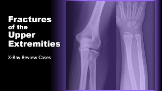 Fractures of the Upper Extremities on XRay radiology xray doctor [upl. by Aiek177]