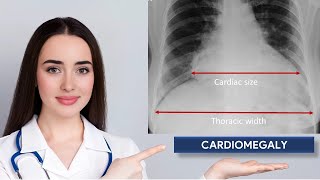 Cardiothoracic Ratio amp Cardiomegaly in Chest Xray [upl. by Dailey]