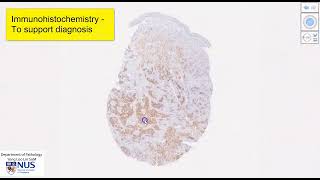 Skin  Metastatic renal cell carcinoma [upl. by Zennas191]