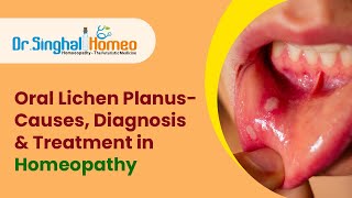 Best Homeopathic Treatment for Lichen PlanusDr Singhal homeo [upl. by Kaehpos]