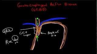 Pathophysiology of Gastroesophageal Reflux Disease GERD [upl. by Gerrilee756]