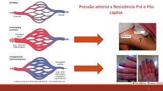 Hiperemia Patologia [upl. by Helbona]