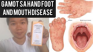 hand foot and mouth disease treatment handfootmouthdisease skininfection [upl. by Kosaka582]