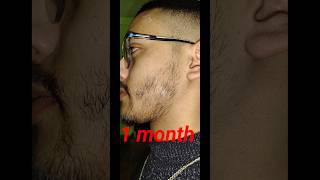 1 month beard growth by minoxidil [upl. by Haimehen]