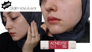 Acnelyse Krem Kullanımı  3 ve 4 Gün  Cildim Soyulmaya Başladı 😯 [upl. by Joeann]