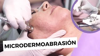 MICRODERMOABRASIÓN FACIAL Protocolo tips y resultados [upl. by Herriott]