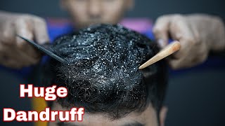 Huge Dandruff Removal From Dry Sculp  ASMR Dandruff Treatment amp Massage  Dandruff Scratching ASMR [upl. by Nwahsor]