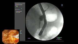 ERCP  Papillitis from recently passing CBD stone [upl. by Taka]