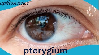 what is Pterygium Pterygium causes symptoms Treatment prevention [upl. by Atterg]