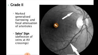 HYPERTENSIVE RETINOPATHY IN HINDI [upl. by Alohcin]