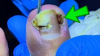 Removing Damaged Toenail and Clean Out Black Dirt Under Nail [upl. by Aiuqal]