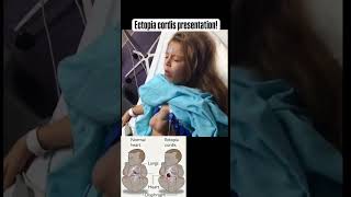 Ectopiacordis congenital birthdefects dysplasia amnioticbandsyndrome congenitalheartdefects [upl. by Toombs360]