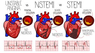 Acute Coronary Syndrome Heart Attack  Unstable Angina vs NSTEMI vs STEMI  With ECGs [upl. by Gathard]