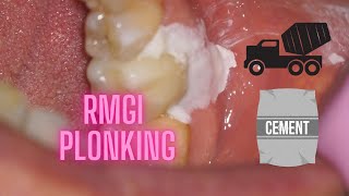 PLONKING conventional crown cementation RMGI cement [upl. by Emelita]